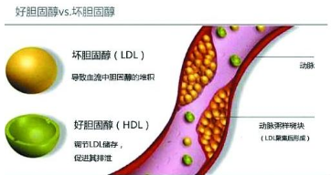 控制膽固醇水平升高是防控冠心病的關鍵舉措