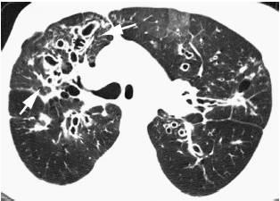 科學家們發(fā)現(xiàn)了一種新方法 可以治療囊性纖維化