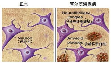 阿爾茨海默氏癥藥物是治療寄生性恰加斯病的有趣候選藥物