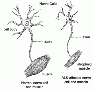 科學(xué)家發(fā)現(xiàn)與ALS嚴重程度有關(guān)的遺傳變異