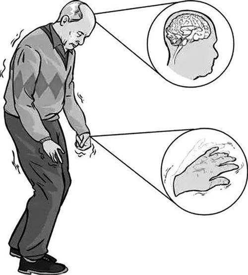 帕金森氏病的自動階段鑒別與生物集成