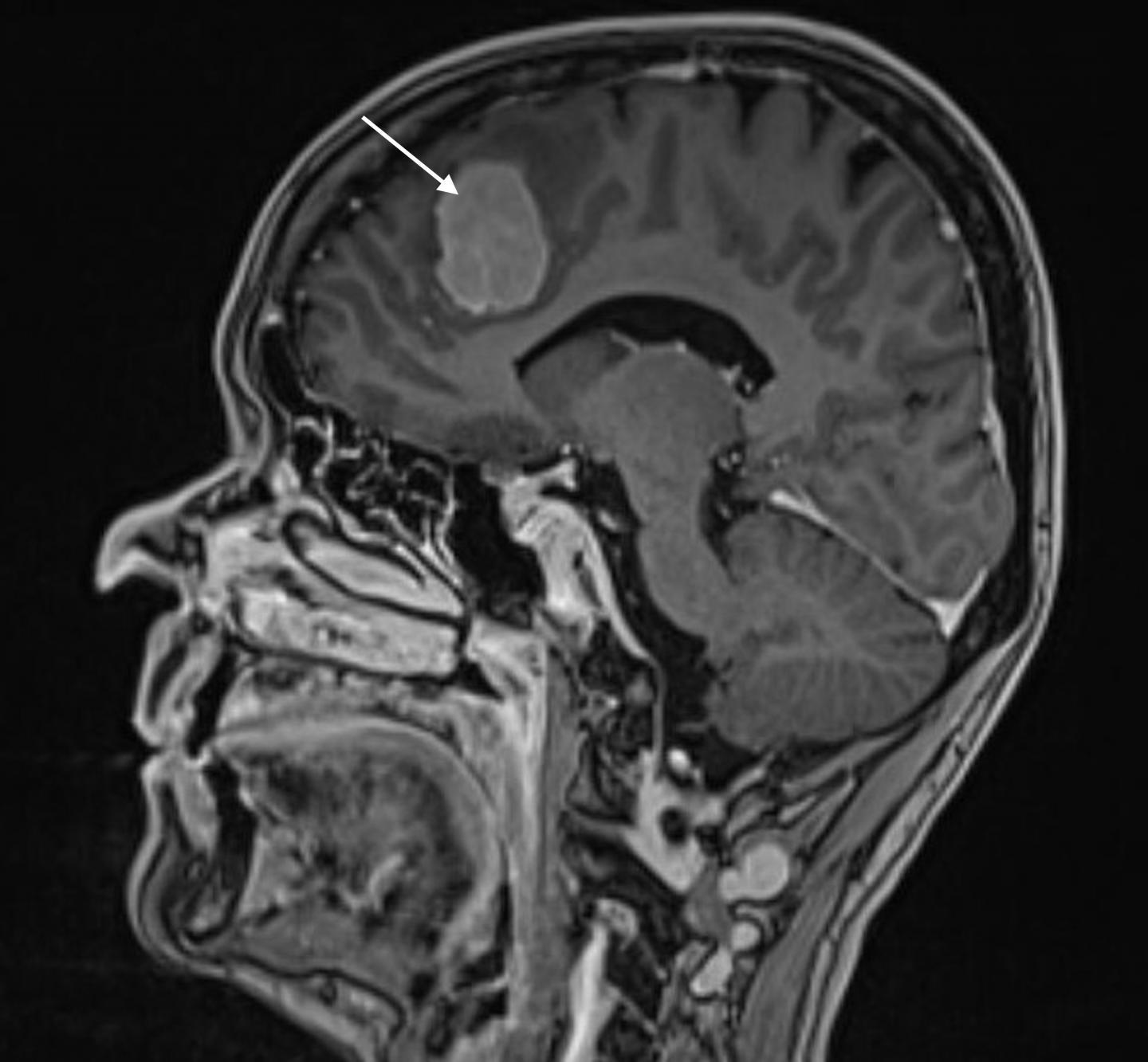 腦膜瘤起源于大腦周圍的腦膜 是最常見的良性腦腫瘤