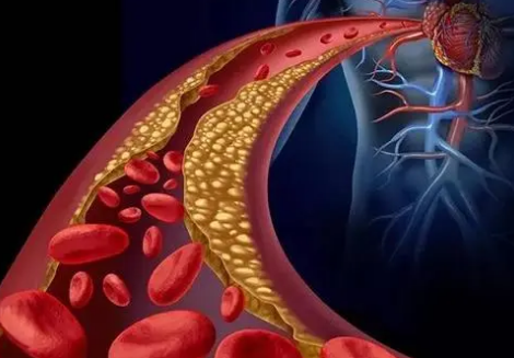 HeartCare研究確定患者患心血管疾病的遺傳風(fēng)險(xiǎn)