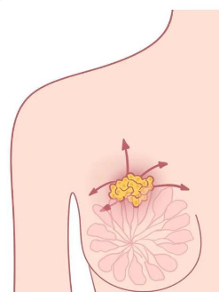 與嗅覺有關(guān)的基因可能在乳腺癌向大腦擴散中發(fā)揮作用