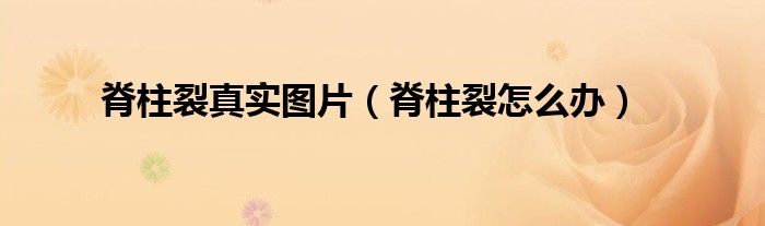 脊柱裂真實圖片（脊柱裂怎么辦）