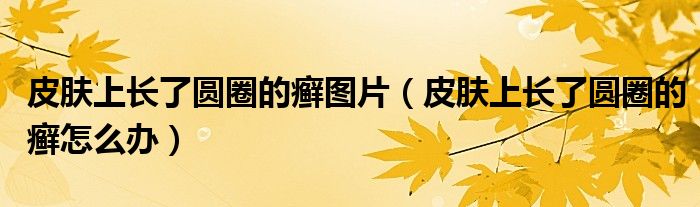 皮膚上長了圓圈的癬圖片（皮膚上長了圓圈的癬怎么辦）