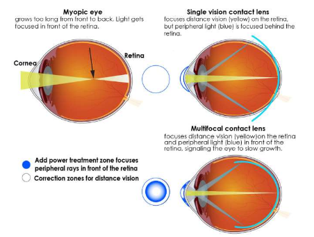多焦點(diǎn)隱形眼鏡可減緩兒童近視加深