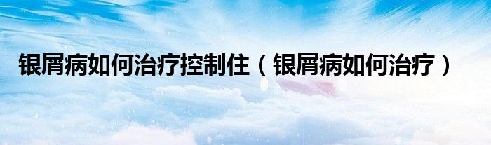 銀屑病如何治療控制?。ㄣy屑病如何治療）