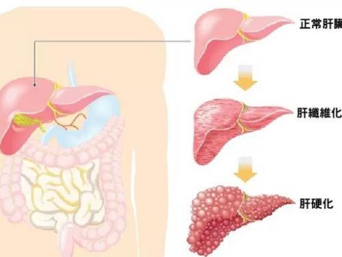 Obeticholic acid改善肝纖維化和NASH的其他組織學(xué)特征