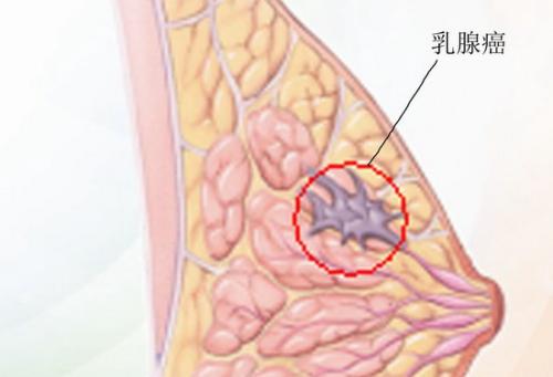 由遺傳主開關(guān)控制的乳腺癌