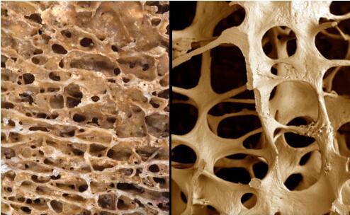 研究發(fā)現(xiàn)35％至50歲的男性中有28％患有骨質(zhì)疏松癥